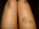 Bruises - Bruises from minor injuries can be treated and healing ...