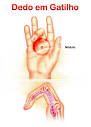 <b>dedos</b> (<b>dedo</b> em <b>gatilho</b>).