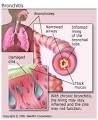 What Is Bronchitis? Acute and Chronic Causes, Picture, and Overview