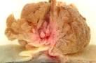villous <b>adenoma</b>