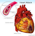Heart Attack Symptoms, Causes, Treatment - What is a heart attack ...
