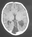 <b>Dandy</b>-<b>Walker</b> Malformation