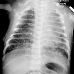 <b>Meconium aspiration syndrome</b>
