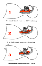 Sleep Apnea - What is sleep apnea, symptoms and treatment | How to ...