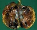 Polycystic <b>kidney</b> disease is a
