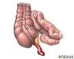 <b>Appendicitis</b>: MedlinePlus