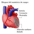 <b>Infarto</b> de <b>Miocardio</b>