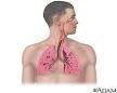 <b>pulmonary fibrosis</b>