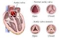 A. Normal <b>Aortic Valve</b> with