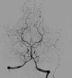 <b>Angiogram</b> showing a transverse