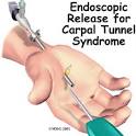 A Patient's Guide to Endoscopic Carpal Tunnel Release