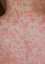 Allergic reaction to amoxicillin | SteadyHealth.