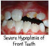 http://www.pediatricdentistsf.com/images/faq_dd_hypo2.jpg