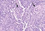 Low-grade <b>endometrial stromal</b>