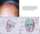 <b>herpes zoster ophthalmicus</b>