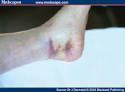 <b>Capillary Leak Syndrome</b>