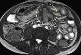 ... in the left side of the abdomen shows local perforation with abscess collection within the mesentery (circle). All images courtesy of Dr. Nyree Griffin. - 2012_04_23_12_34_00_113_2012_04_24_griffin_fig1