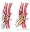 Endarterectomy