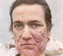  Cystic Acne Remedies