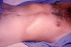 and <b>paratyphoid fever</b>,