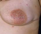 Eczema Areola Photo - Skin Disease Pictures