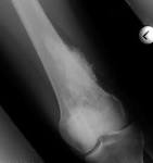 Parosteal <b>osteosarcoma</b>