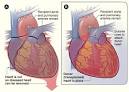 What To Expect During a Heart Transplant - NHLBI, NIH