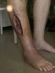 File:Fasciotomy <b>leg</b>.jpg