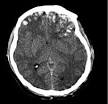 Traumatic brain injury - Wikipedia, the free encyclopedia
