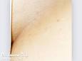 bikini-hair-removal-after. ...