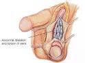 <b>Varicocele</b> In Testicles