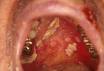 <b>Mucositis</b> with candida