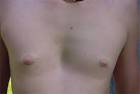 <b>funnel</b>/<b>chest</b>/exam/huss.htm
