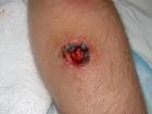 staph <b>infection</b>
