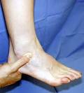 Ankle Sprains -- Dr. Chris Chiodo