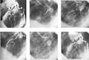 Angina Pectoris - anterior chest pain due to a partially blocked ...