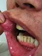 230px-Behcets_disease.jpg