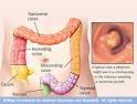 Colorectal cancer