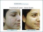  Laser Treatments For Acne Scars   How Does It Work?