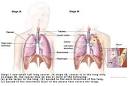 Nursing Interventions for Lung Cancer | Nursing Crib