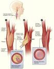 Vascular &amp; Endovascular Surgery - Carotid Endarterectomy
