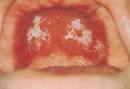 <b>Denture stomatitis</b>