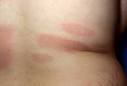 <b>Erythema Chronicum Migrans</b>