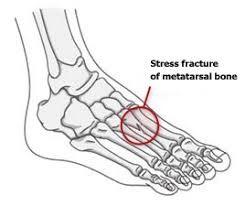 Stress Fracture Barefoot Running