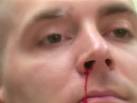 EPISTAXIS Management - Procedures CONSULT JAPAN