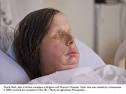 Woman Shows Her New Face After Being Attacked By A Chimpanzee ...