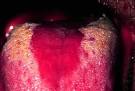 Pictures of <b>Glossitis</b> :