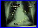 Lung Cancer (Adenocarcinoma of the Lung)