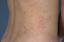 Angiokeratoma corporis diffusum (Fabry disease)