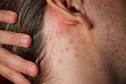 Types of Skin Rashes - Life123